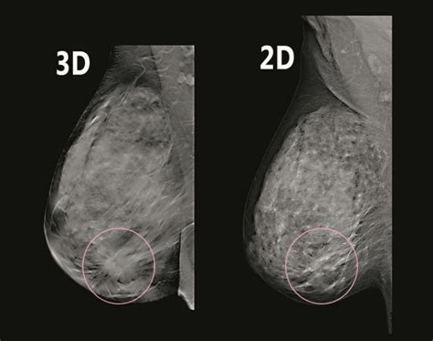 3d mammography – Diagnostic Outpatient Imaging