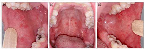 Koplik’s Spots - Focus Dentistry