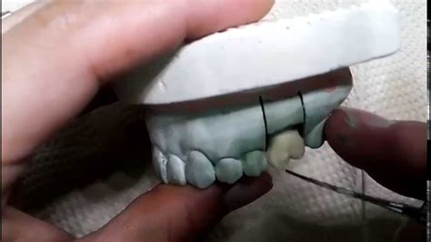 Dental wax up - YouTube