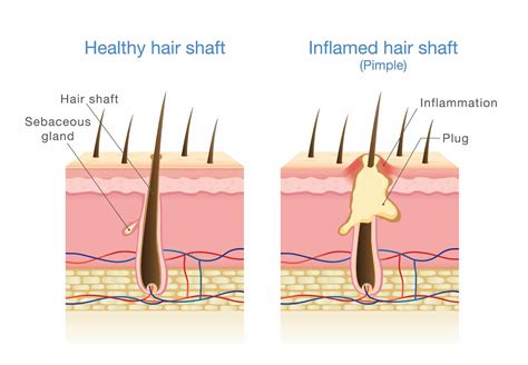 Infected Hair Follicle