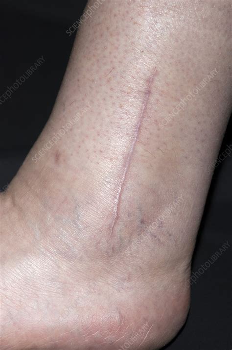 Scar on a fractured ankle - Stock Image - M332/0164 - Science Photo Library