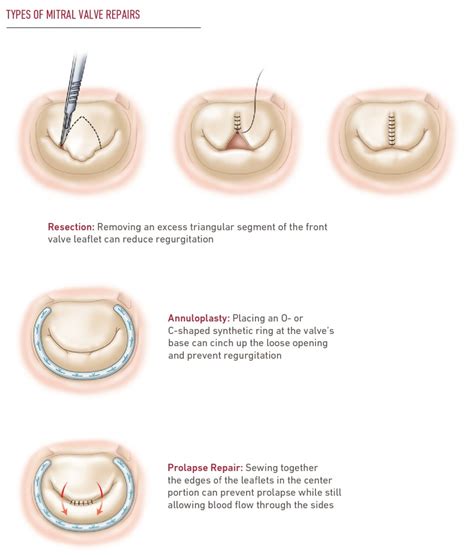 Mitral Valve Repair & Replacement | Temple Health