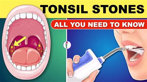 Tonsil Stones | Tonsil Stones Treatment | Tonsil Stone Removal - All ...