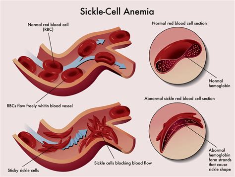 Treat/Cure Sickle Cell Anemia Naturally With Body Oxygen and Breath