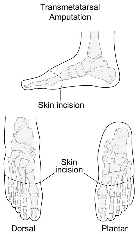 Transmetatarsal Amputation (TMA) and Toe Amputation | Treatments ...