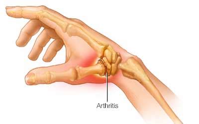 Is Thumb Joint Replacement Surgery Right for You? - Tanya Coats OT