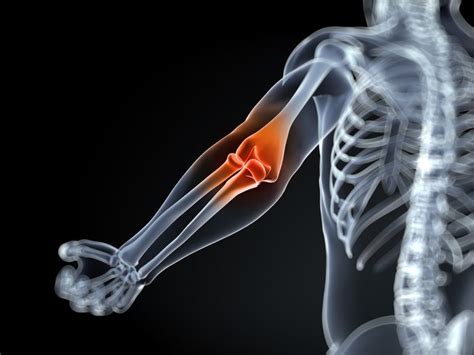 What You Need to Know About Inflammatory Arthritis