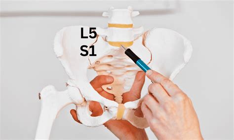 L5-S1 Pain and its Causes, Symptoms, and Treatment : Performance Pain ...