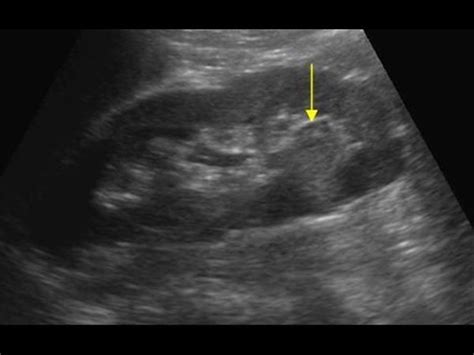 Image result for renal cell carcinoma ultrasound | Renal cell carcinoma ...