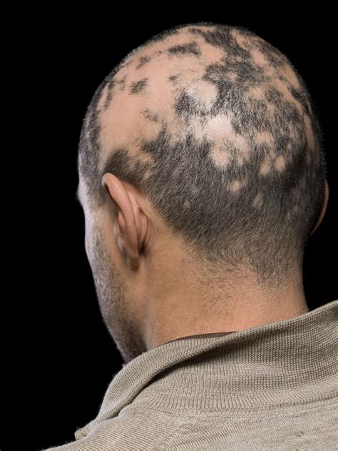 Current alopecia areata options include old and new therapies | MDedge ...