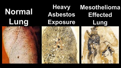 Health risks of asbestos – TADEX