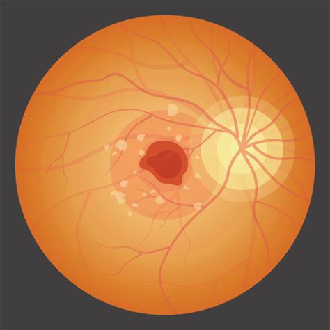 Macular Holes Macon | Macular Pucker Warner Robins | Retina Associates