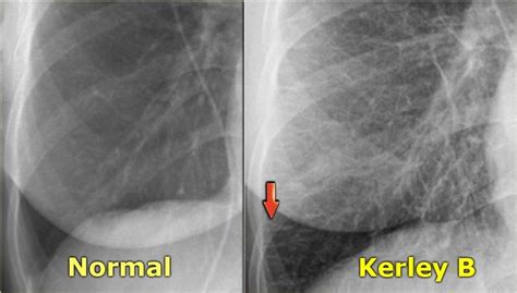 kerley b | Lung disease, Radiology imaging, Lunges