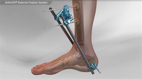 Arthrex - ArthroFX® External Fixation System