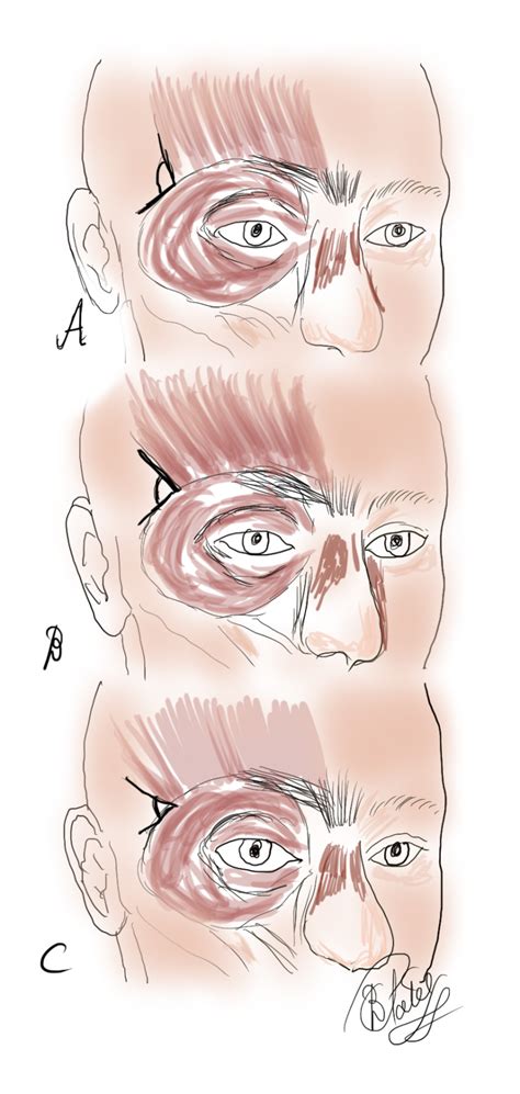 Anatomy, Head and Neck; Frontalis Muscle - StatPearls - NCBI Bookshelf