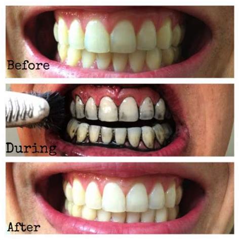 Extreme Activated Charcoal Teeth Whitening Gel | Coal Teeth Whitening