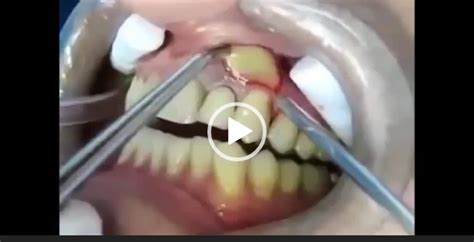 tooth cyst removal | Viral On The Web Now