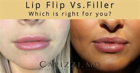 Lip Flip Botox Before And After Photos - Infoupdate.org