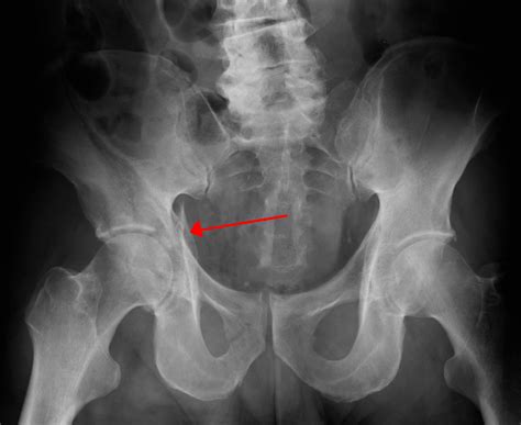 Pelvic Fracture