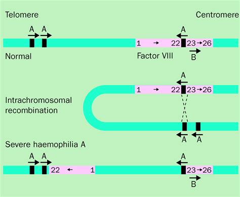 Haemophilias A and B - The Lancet