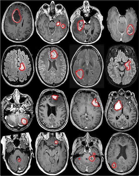 Cat Scan Brain Tumor