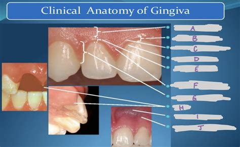 Clinical Anatomy of the Gingiva Diagram | Quizlet