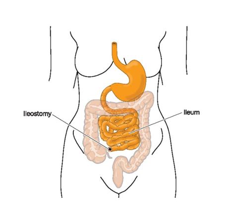 Ileostomy | Ileostomy, Ostomy, Colostomy