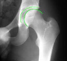 Hip arthritis Cause, Symptoms, X-Ray, Treatment, Exercises