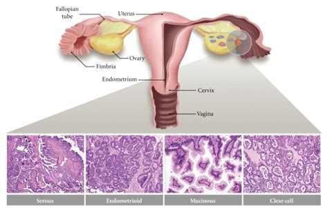 The major histologic subtypes of ovarian carcinoma. Serous carcinomas ...