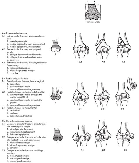 Replacement Arthroplasty for Acute Fractures | Musculoskeletal Key