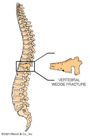 Is Your Doctor Screening for Silent Fractures? - Osteoporosis ...