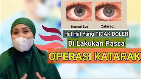 PERAWATAN SETELAH OPERASI KATARAK - EDUKASI PERAWATAN MATA SETELAH ...