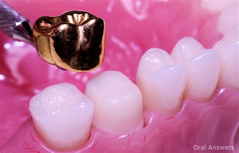 How Can Gold Fillings and Crowns Work When Gold Is So Soft? | Oral Answers