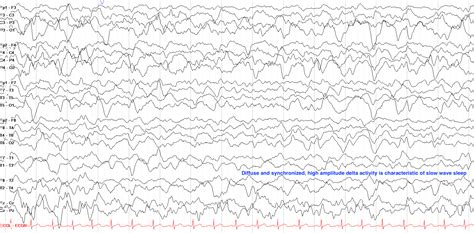 The Normal Asleep EEG