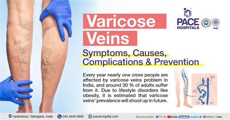 Varicose Veins Causes Symptoms And Treatments Explained – NBKomputer