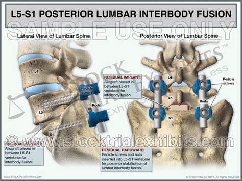 L5-S1 Posterior Lumbar Interbody Fusion (PLIF) – Stock Trial Exhibits