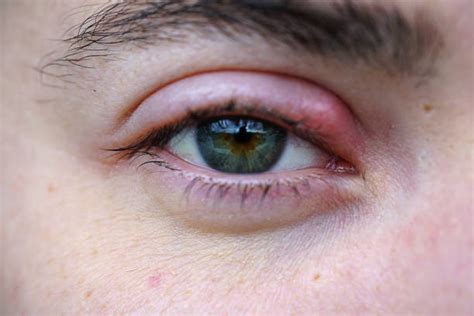 Stye Infection Stock Photos, Pictures & Royalty-Free Images - iStock