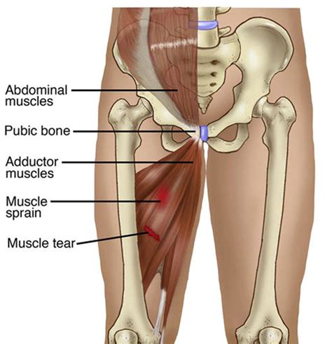 Groin Strain/Adductor Tendinopathy | Complete Physio