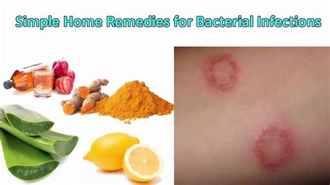 5 Homemade Remedies for Bacterial Infections By Homemade Remedies - YouTube