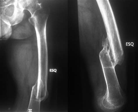 X‑ray in anteroposterior and lateral views of the left femur. Note the ...