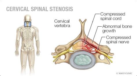 Mayo Clinic Q and A: Treating cervical spinal stenosis - Mayo Clinic ...