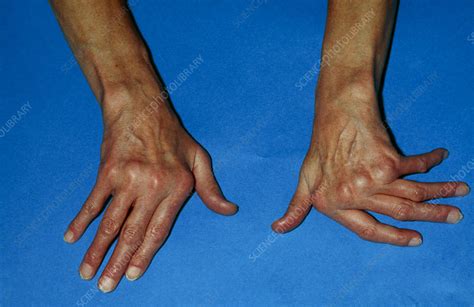 Rheumatoid arthritis of hand - Stock Image - M110/0280 - Science Photo ...