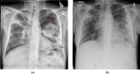 Incidental Spontaneous Pneumothorax in a Patient with Recently ...