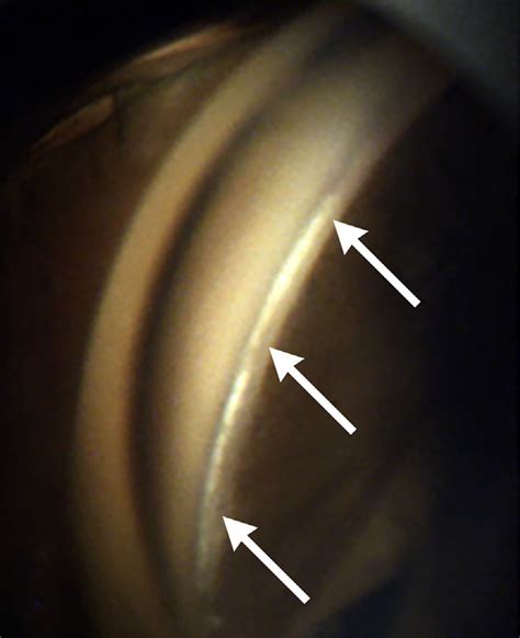 The anterior wall of Schlemm canal (white tissue indicated by the white ...