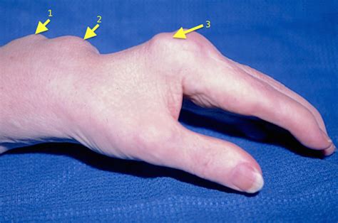 Synovitis | Hand Surgery Resource