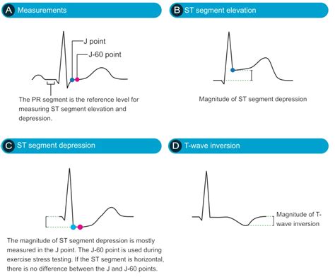 NSTEMI (Non ST Elevation Myocardial Infarction) Unstable, 51% OFF