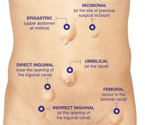 Best Hospital for Hernia Treatment: Pace Hospitals