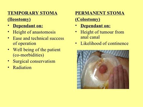 The Surgery for Rectal Cancer