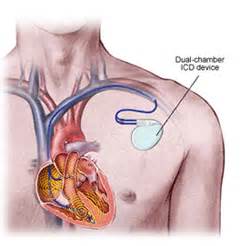 Implantable Cardioverter Defibrillator (ICD) | Willard Walker Heart ...