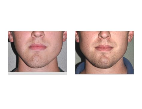 Asymmetrical Jawlines: Causes And Treatments | Justinboey